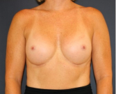Feel Beautiful - Natural Breast Augmentation 012 - After Photo